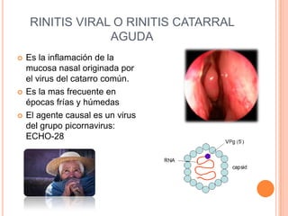 RINITIS VIRAL O RINITIS CATARRAL
AGUDA
 Es la inflamación de la
mucosa nasal originada por
el virus del catarro común.
 Es la mas frecuente en
épocas frías y húmedas
 El agente causal es un virus
del grupo picornavirus:
ECHO-28
 