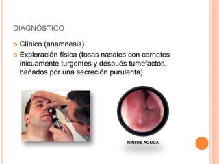 DIAGNÓSTICO
 Clínico (anamnesis)
 Exploración física (fosas nasales con cornetes
inicuamente turgentes y después tumefactos,
bañados por una secreción purulenta)
RINITIS AGUDA
 
