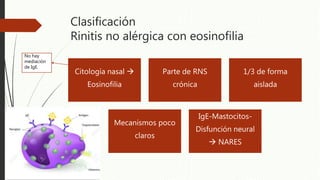 Clasificación
Rinitis no alérgica con eosinofilia
Citología nasal 
Eosinofilia
Parte de RNS
crónica
1/3 de forma
aislada
Mecanismos poco
claros
IgE-Mastocitos-
Disfunción neural
 NARES
No hay
mediación
de IgE.
 