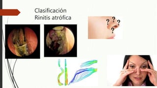 Clasificación
Rinitis atrófica
 