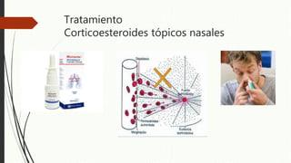 Tratamiento
Corticoesteroides tópicos nasales
 