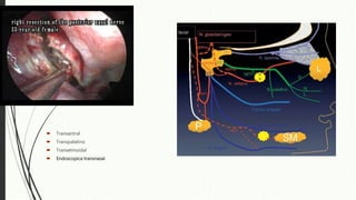  Transantral
 Transpalatino
 Transetmoidal
 Endoscopica transnasal
 