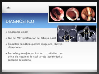 DIAGNÓSTICO
 Rinoscopia simple
 TAC del MCF: perforación del tabique nasal
 Biometría hemática, química sanguínea, EGO sin
alteraciones
 Benzoilecgonina(determinacion cualitativa en
orina de cocaina) la cual arrojo positividad a
consumo de cocaina.
 