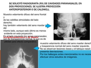 SE SOLICITÓ RADIOGRAFÍA (RX) DE CAVIDADES PARANASALES, EN
DOS PROYECCIONES. SE ILUSTRA PROYECCIÓN
ANTEROPOSTERIOR O DE CALDWELL
occipitomentoniana o de Waters
Muestra velamiento difuso del seno frontal
y
de las celdillas etmoidales del lado
derecho;
hay también velamiento del seno maxilar
del
mismo lado, aunque esto último es menos
evidente en esta proyección.
En el lado izquierdo los senos paranasales
son de transparencia normal, lo que es de
utilidad para efecto comparativo.
muestra velamiento difuso del seno maxilar derech
y trasparencia normal del seno maxilar izquierdo.
No se observan lesiones óseas y el tabique nasal n
presenta desviaciones.
Por los hallazgos antes mencionados no es necesa
efectuar otros estudios de imágenes.
 
