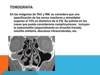 TOMOGRAFIA
En las imágenes de TAC y RM, se considera que una
opacificación de los senos maxilares y etmoidales
superior al 75% es distintivo de la FQ. Se solicita en los
casos que pueda considerarse complicaciones: incluyen
la osteomielitis (especialmente en sinusitis frontal),
celulitis orbitaria, abscesos intracerebrales, etc.
 