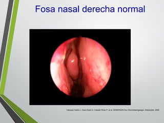Fosa nasal derecha normal
Vázquez Castro J, Cano Espín A, Casado Pérez P, et al. SEMERGEN Doc Otorrinolaringología. Edicomplet. 2009.
 