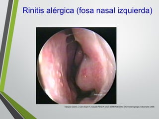 Rinitis alérgica (fosa nasal izquierda)
Vázquez Castro J, Cano Espín A, Casado Pérez P, et al. SEMERGEN Doc Otorrinolaringología. Edicomplet. 2009.
 
