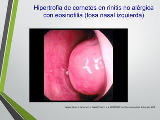 Hipertrofia de cornetes en rinitis no alérgica
con eosinofilia (fosa nasal izquierda)
Vázquez Castro J, Cano Espín A, Casado Pérez P, et al. SEMERGEN Doc Otorrinolaringología. Edicomplet. 2009.
 