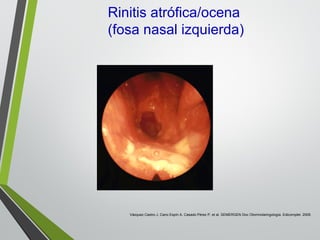 Rinitis atrófica/ocena
(fosa nasal izquierda)
Vázquez Castro J, Cano Espín A, Casado Pérez P, et al. SEMERGEN Doc Otorrinolaringología. Edicomplet. 2009.
 