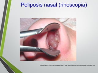 Poliposis nasal (rinoscopia)
Vázquez Castro J, Cano Espín A, Casado Pérez P, et al. SEMERGEN Doc Otorrinolaringología. Edicomplet. 2009.
 