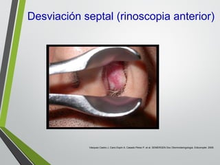 Desviación septal (rinoscopia anterior)
Vázquez Castro J, Cano Espín A, Casado Pérez P, et al. SEMERGEN Doc Otorrinolaringología. Edicomplet. 2009.
 