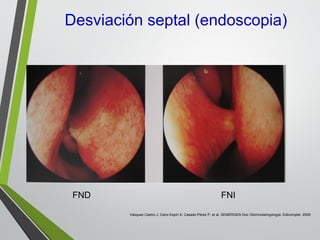 Desviación septal (endoscopia)
FND FNI
Vázquez Castro J, Cano Espín A, Casado Pérez P, et al. SEMERGEN Doc Otorrinolaringología. Edicomplet. 2009.
 
