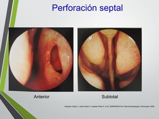 Perforación septal
Anterior Subtotal
Vázquez Castro J, Cano Espín A, Casado Pérez P, et al. SEMERGEN Doc Otorrinolaringología. Edicomplet. 2009.
 