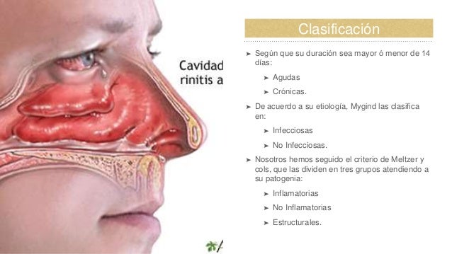Sinusitis Rhinitis Y Sinusitis Rhinitis Y