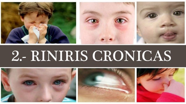 Sinusitis Y Rinitis Diferencia