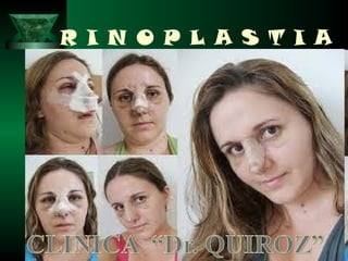 R I N O P L A S T I A
 