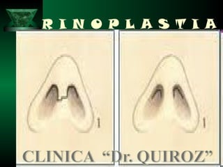 R I N O P L A S T I A
 