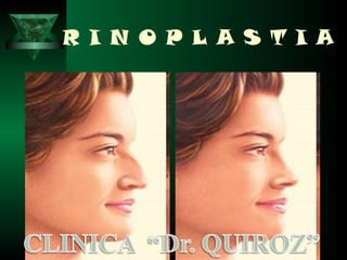 R I N O P L A S T I A
 