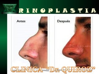 R I N O P L A S T I A
 