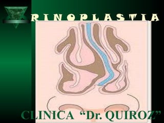 R I N O P L A S T I A
 