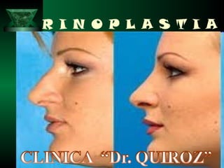 R I N O P L A S T I A
 