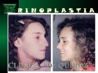 R I N O P L A S T I A
 