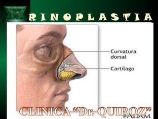 R I N O P L A S T I A
 