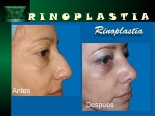 R I N O P L A S T I A
 