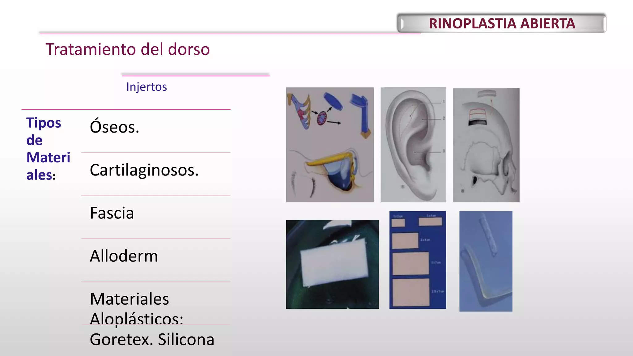 Rinoplastia abierta. por Hanmer Roa . 2021 | PPTX | Ear, Nose and ...