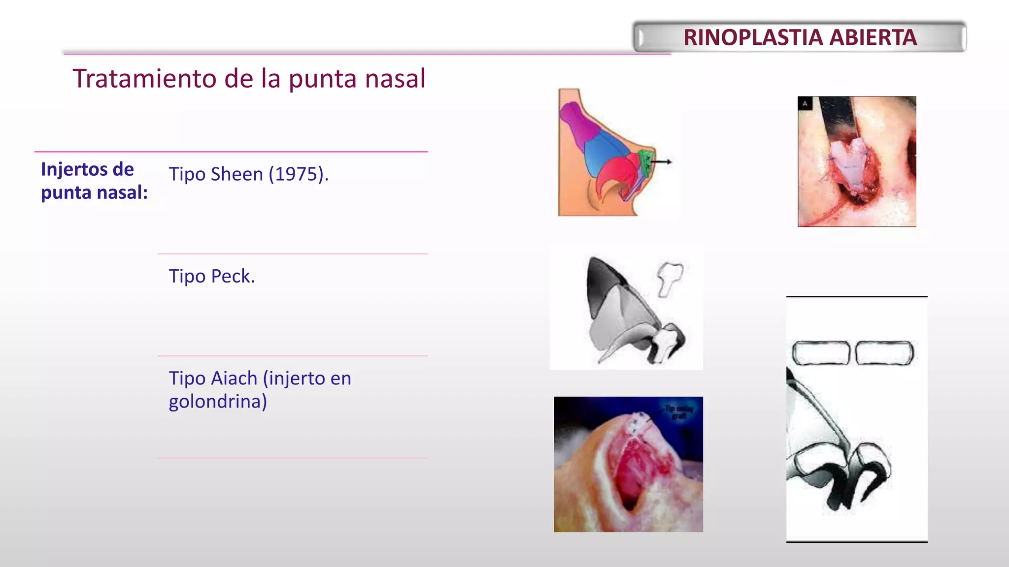 Rinoplastia abierta. por Hanmer Roa . 2021 | PPTX | Ear, Nose and ...