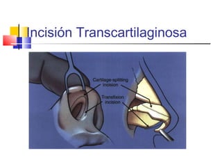 Incisión Transcartilaginosa 
 