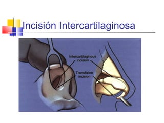 Incisión Intercartilaginosa 
 
