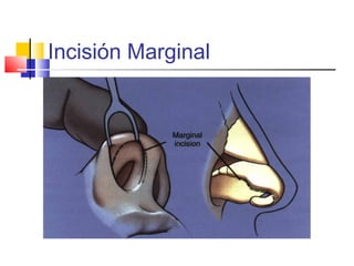 Incisión Marginal 
 