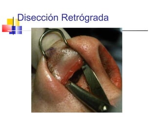Disección Retrógrada 
 