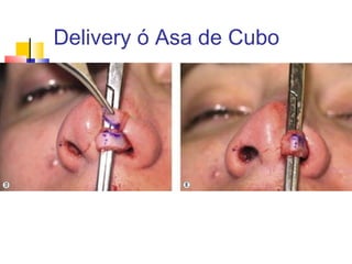 Delivery ó Asa de Cubo 
 