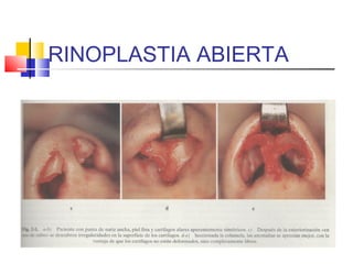 RINOPLASTIA ABIERTA 
 