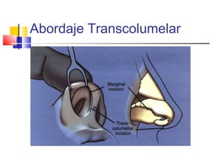 Abordaje Transcolumelar 
 