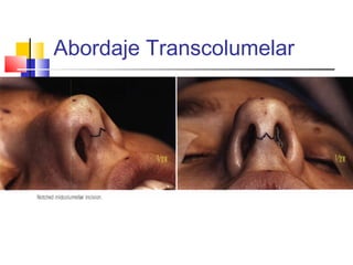 Abordaje Transcolumelar 
 