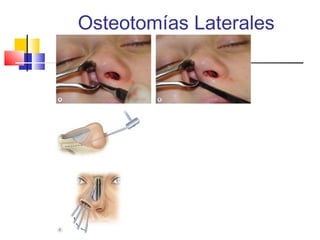 Osteotomías Laterales 
 