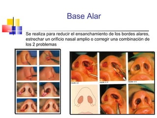 Base Alar 
 Se realiza para reducir el ensanchamiento de los bordes alares, 
estrechar un orificio nasal amplio o corregir una combinación de 
los 2 problemas 
 
