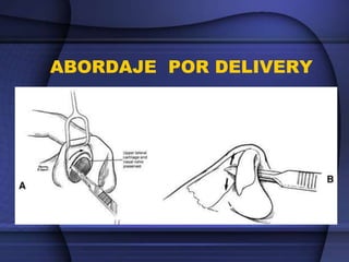 ABORDAJE POR DELIVERY
 