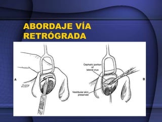ABORDAJE VÍA
RETRÓGRADA
• VIA TRASCARTILAGINOSA
 