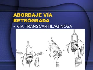 ABORDAJE VÍA
RETRÓGRADA
• VIA TRANSCARTILAGINOSA
 