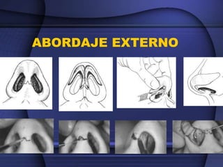 ABORDAJE EXTERNO
 