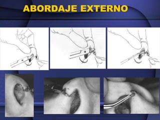 ABORDAJE EXTERNO
 