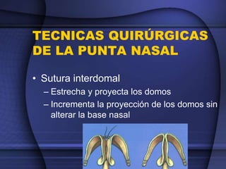 TECNICAS QUIRÚRGICAS
DE LA PUNTA NASAL
• Sutura interdomal
– Estrecha y proyecta los domos
– Incrementa la proyección de los domos sin
alterar la base nasal
 