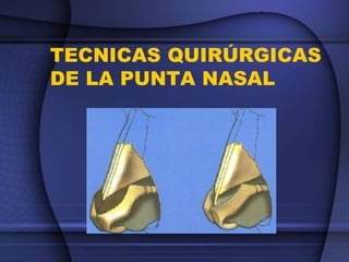 TECNICAS QUIRÚRGICAS
DE LA PUNTA NASAL
 