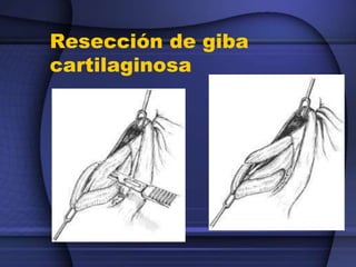 Resección de giba
cartilaginosa
 