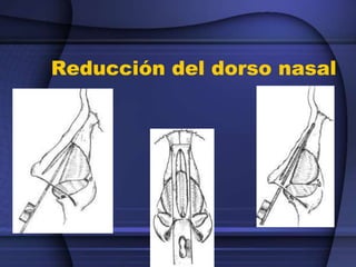 Reducción del dorso nasal
 