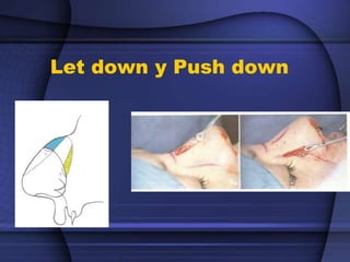 Let down y Push down
 